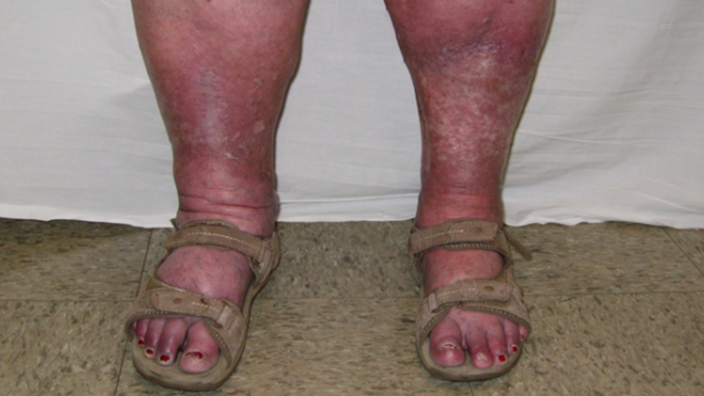 Understanding Lower Extremity Phlebolymphedema Fibrosis