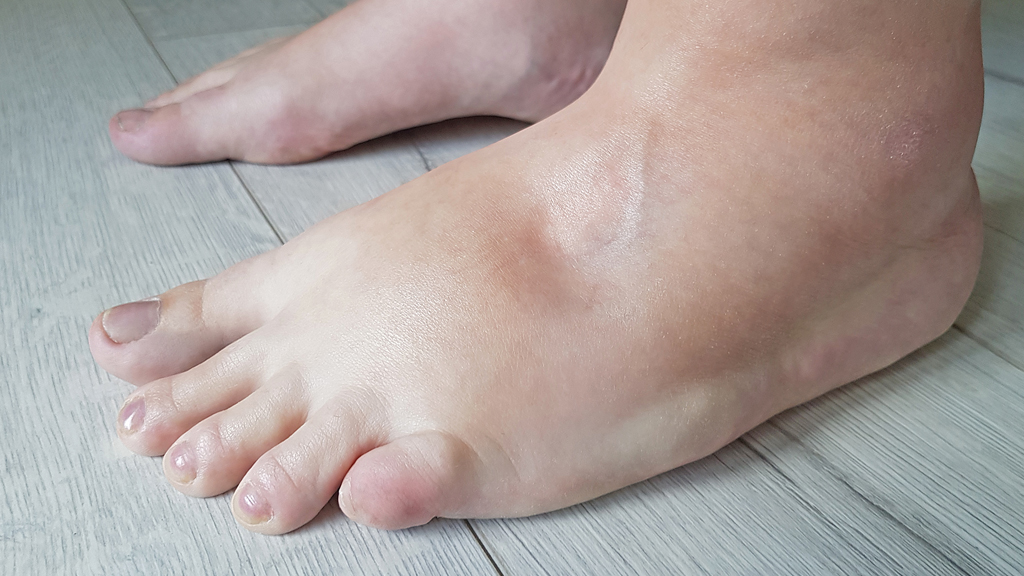 Do You Know the Signs and Symptoms of Lymphedema?
