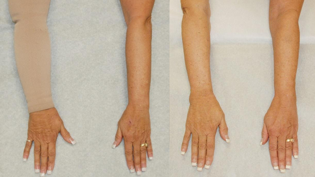 How Lymphatic Surgery Works Hand-in-Hand With Compression Therapy