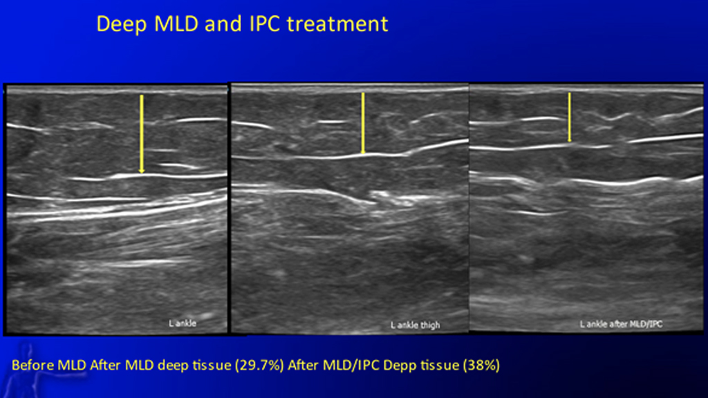 Tools for Lipedema Treatment