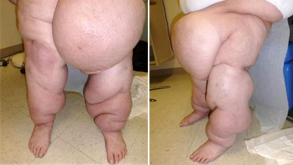 Example of a patient with lipedema referred with a mistaken