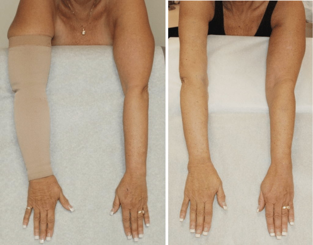 lymphedema arm comparison