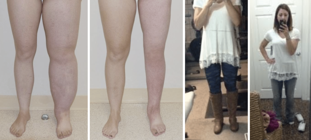 lymphedema legs