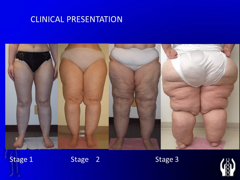 Case Studies and Insights into Lipedema and Dercum's Disease