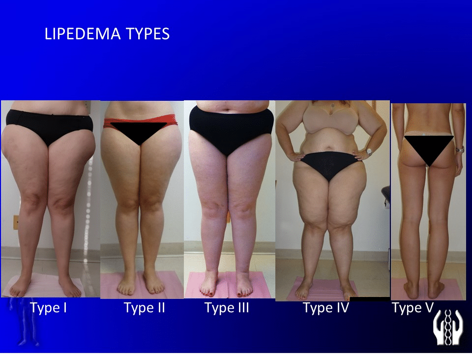 Case Studies and Insights into Lipedema and Dercum's Disease