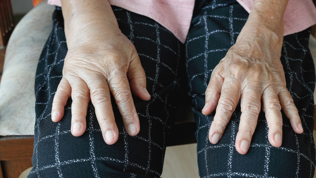 The Four Lymphedema Stages From Symptoms To Treatment