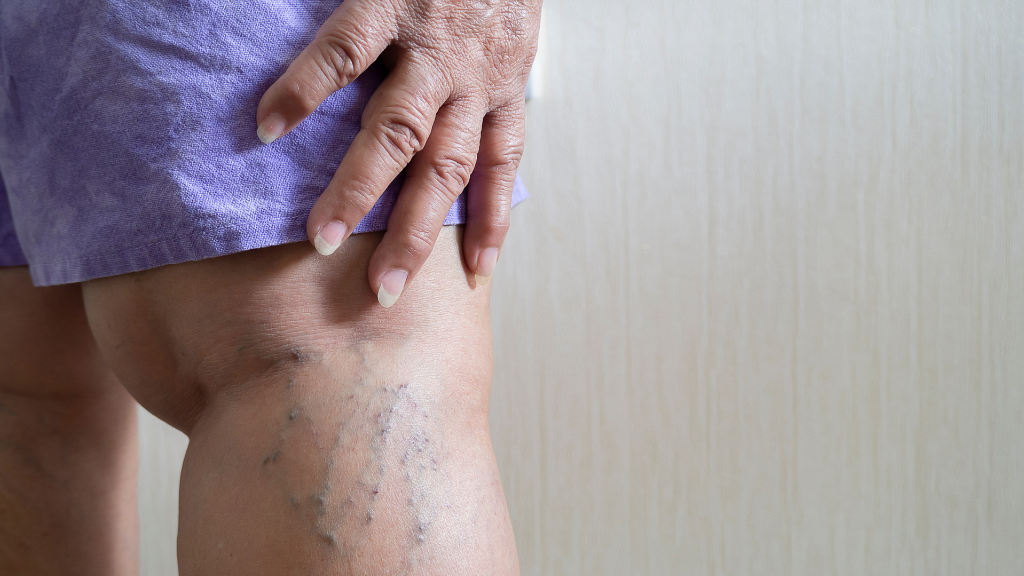 A close-up of an older woman placing her hand on her leg, which is swollen with visible veins.